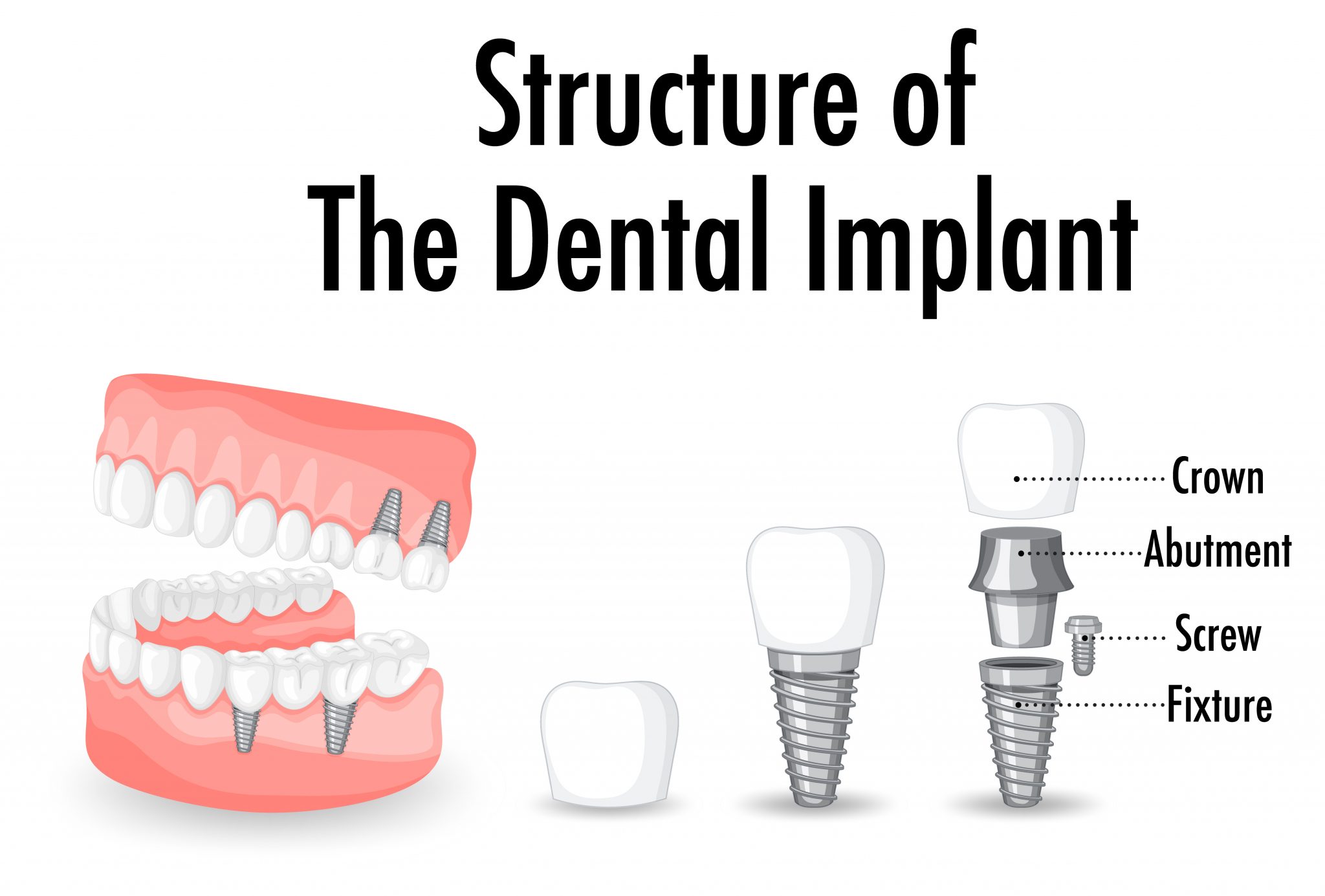 Dental Implants & Tooth Extractions Quayside Dental Centre