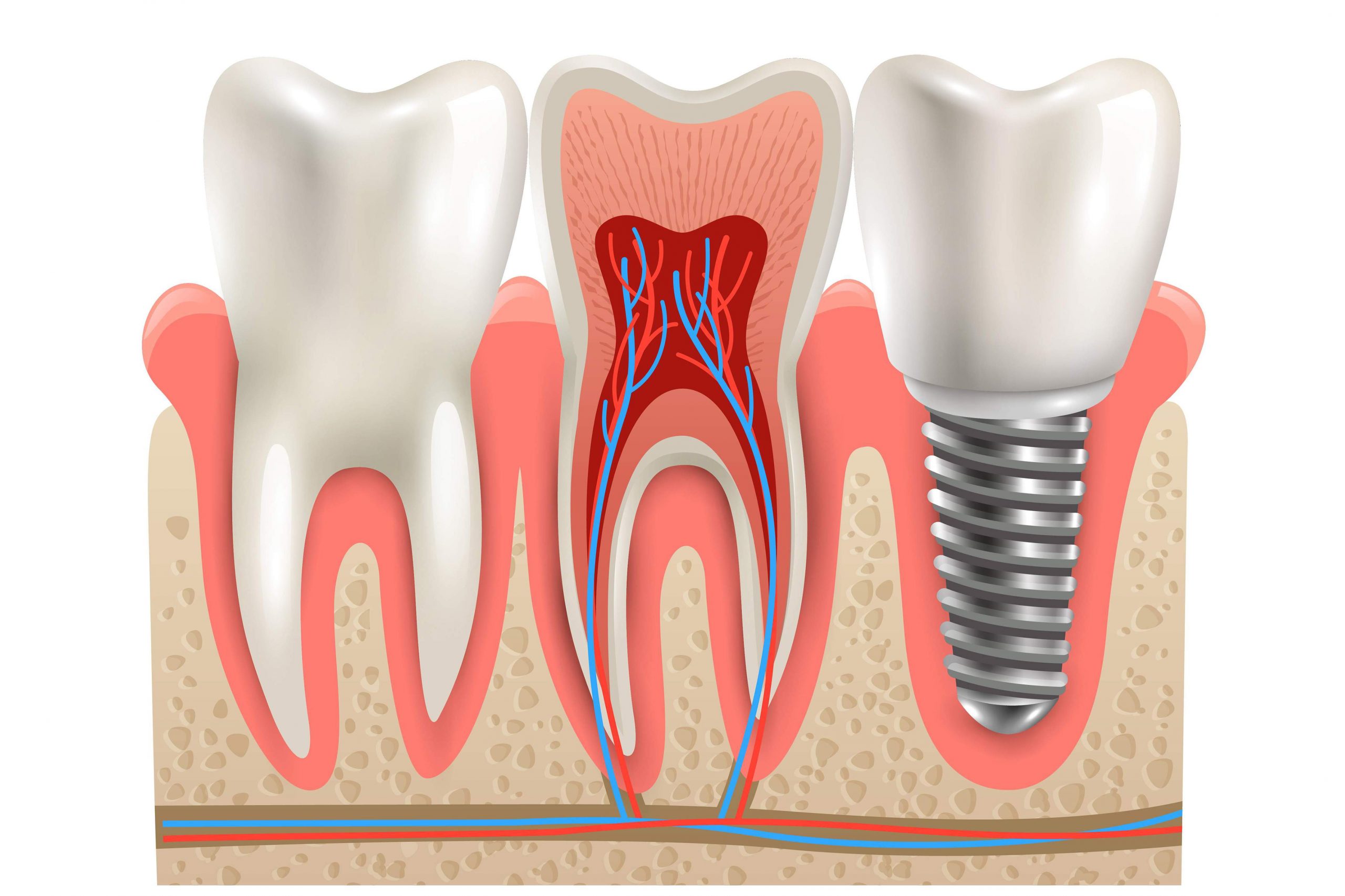 https://dentistinnorthvancouver.com/wp-content/uploads/2022/12/implant-scaled.jpg